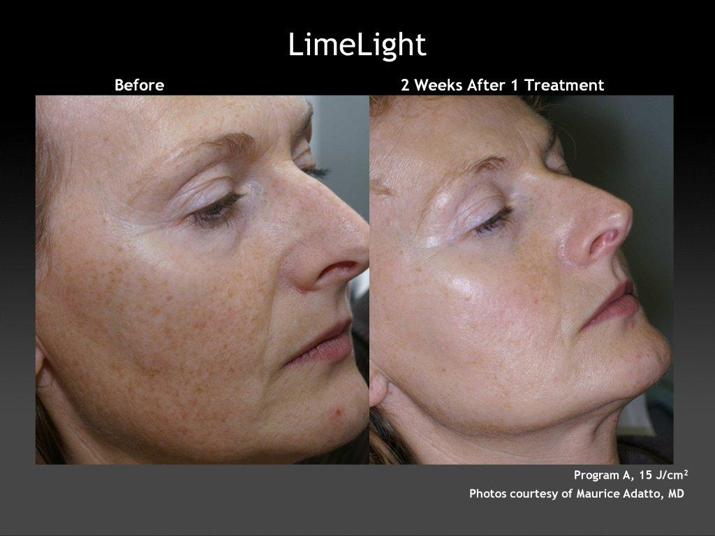 Mariposa Aesthetics & Laser Center LimeLight IPL Photofacial by Cutera®