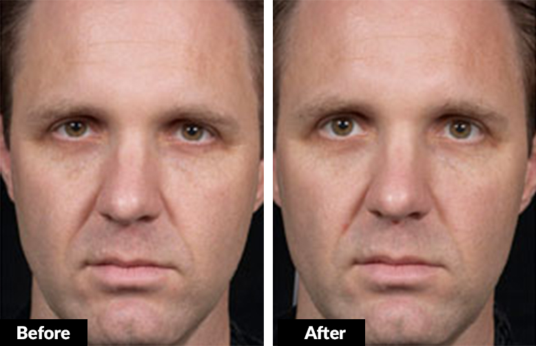 Mariposa Aesthetics & Laser Center Clear Brilliant Laser Skin Treatment