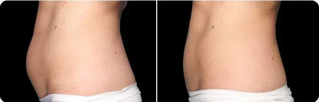 Mariposa Aesthetics & Laser Center Coolsculpting Elite Body Contouring Treatment