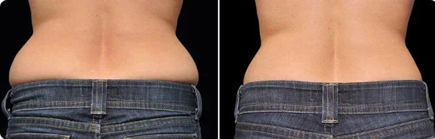 Mariposa Aesthetics & Laser Center Coolsculpting Elite Body Contouring Treatment