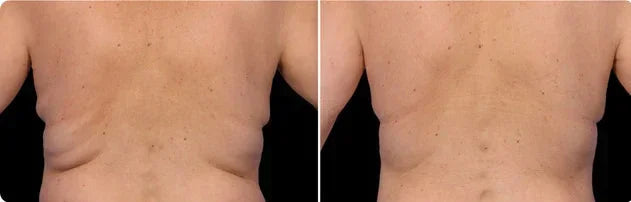 Mariposa Aesthetics & Laser Center Coolsculpting Elite Body Contouring Treatment