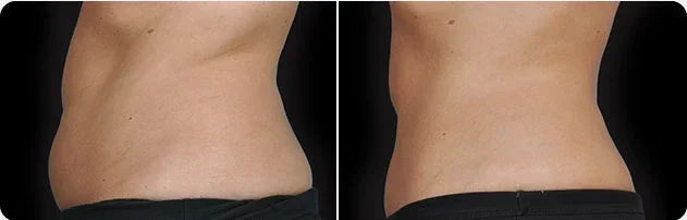Mariposa Aesthetics & Laser Center Coolsculpting Elite Body Contouring Treatment