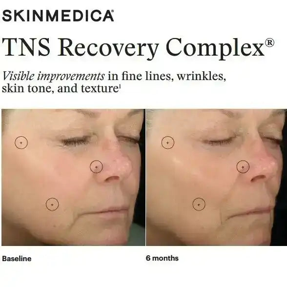 SkinMedica TNS Recovery Complex before and after results showing improved skin texture and wrinkles.