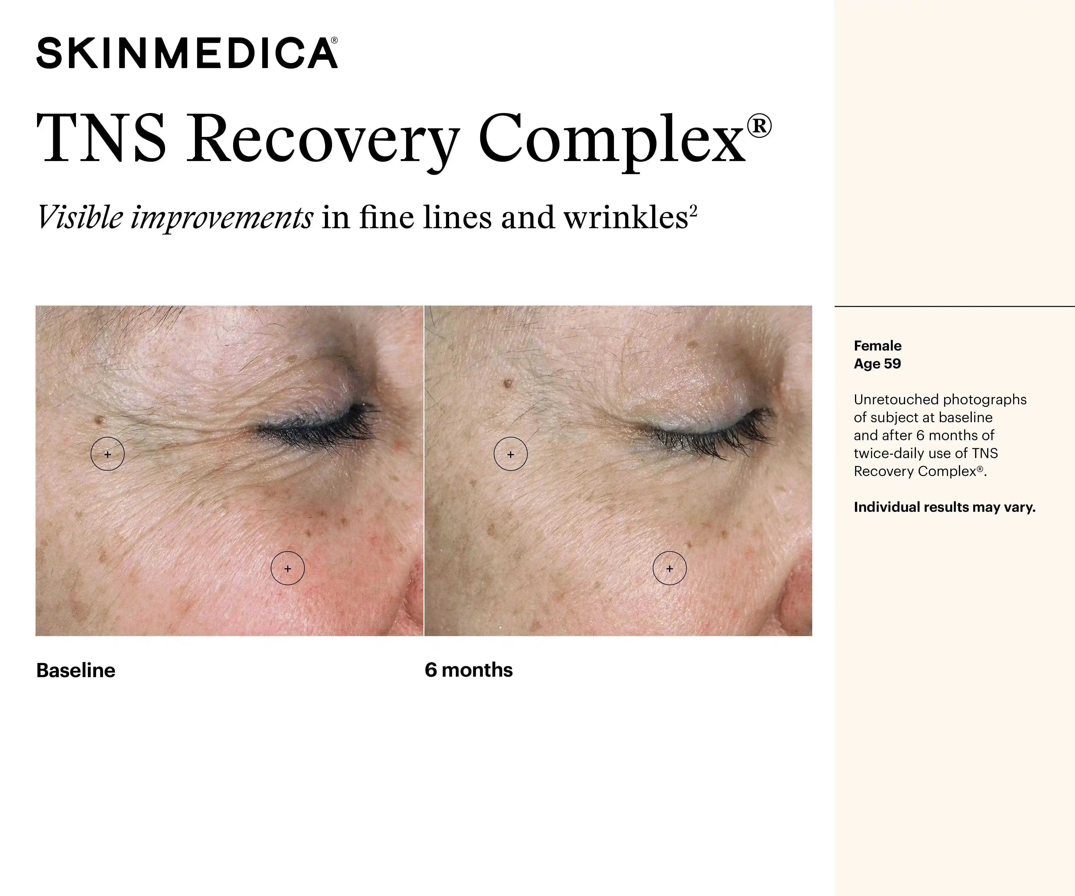 Before and after photos of a 59-year-old female showing reduction in wrinkles after 6 months of SkinMedica TNS Recovery Complex.