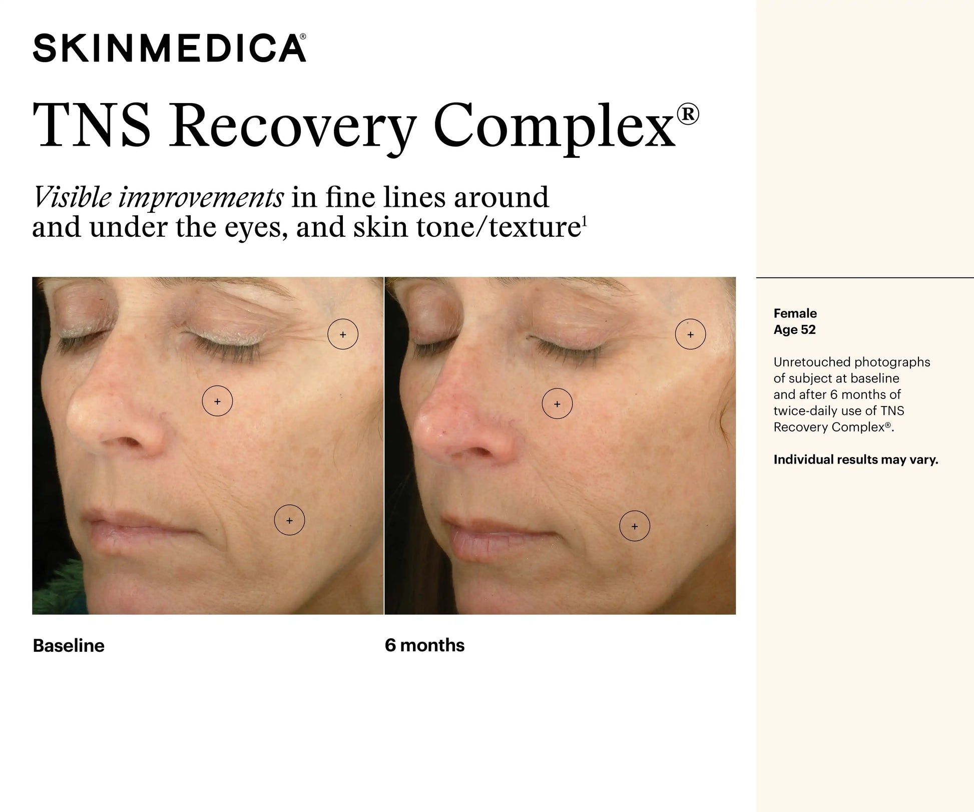 Before and after photos of a 52-year-old female using SkinMedica TNS Recovery Complex for 6 months.