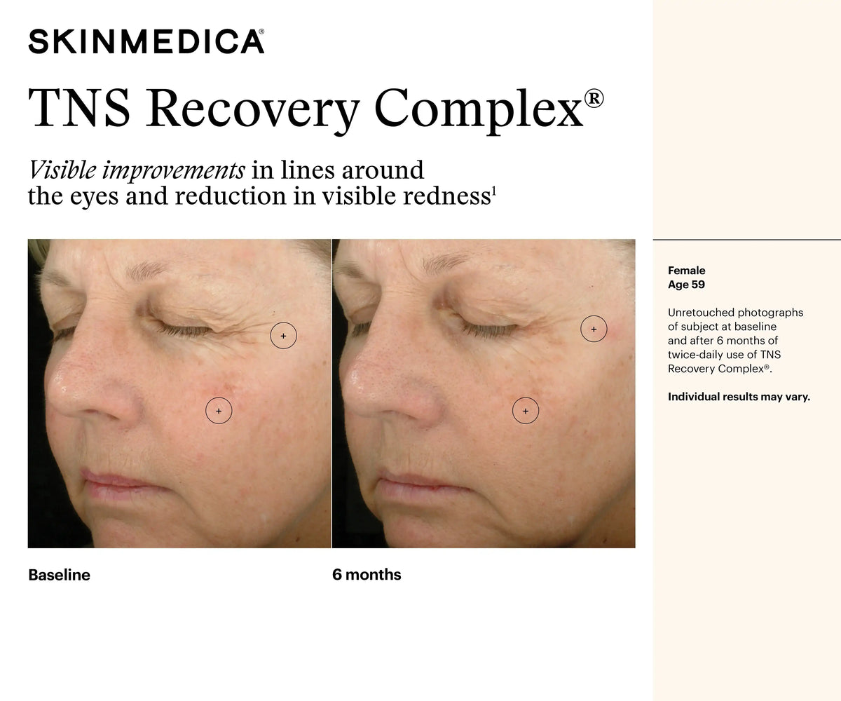 Before and after comparison of a 59-year-old female showing SkinMedica TNS Recovery Complex results.