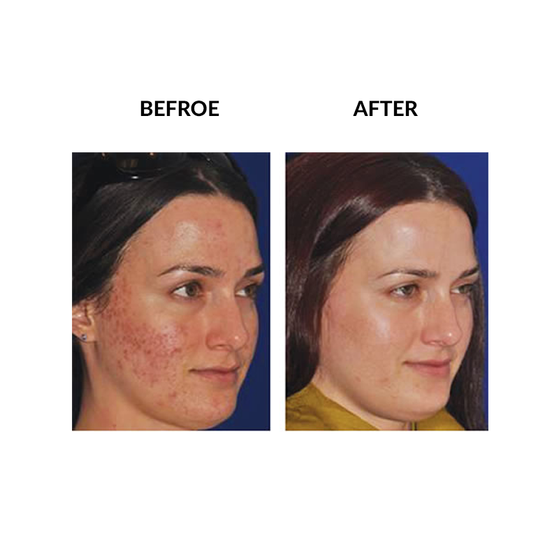 Mariposa Aesthetics & Laser Center Micropen PRP Skin Therapy Rejuvenation