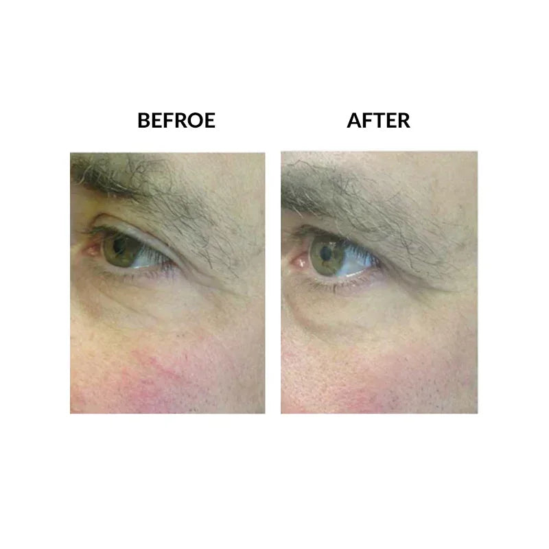 Mariposa Aesthetics & Laser Center Micropen PRP Skin Therapy Rejuvenation