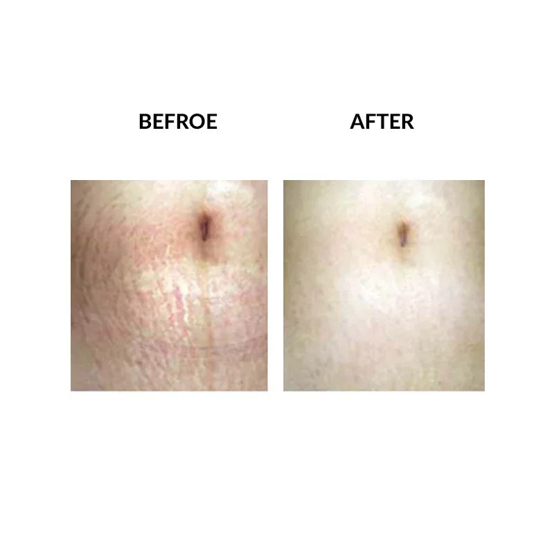 Mariposa Aesthetics & Laser Center Micropen PRP Skin Therapy Rejuvenation