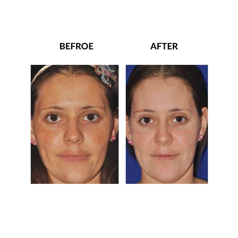 Mariposa Aesthetics & Laser Center Micropen PRP Skin Therapy Rejuvenation