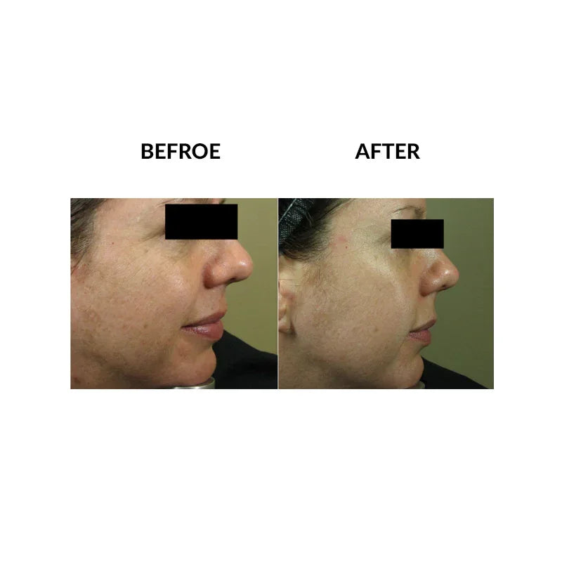 Mariposa Aesthetics & Laser Center Micropen PRP Skin Therapy Rejuvenation