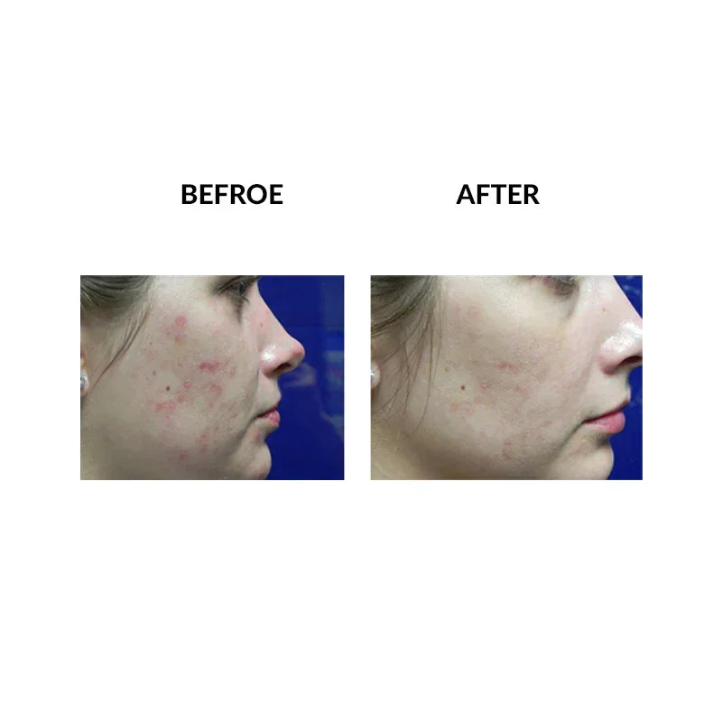 Mariposa Aesthetics & Laser Center Micropen PRP Skin Therapy Rejuvenation