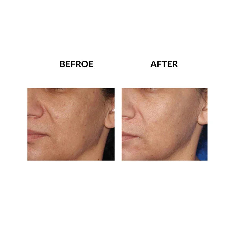 Mariposa Aesthetics & Laser Center Micropen PRP Skin Therapy Rejuvenation