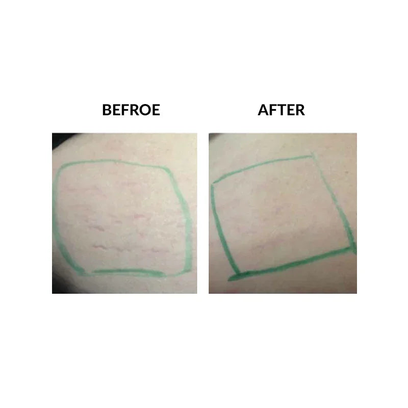 Mariposa Aesthetics & Laser Center Micropen PRP Skin Therapy Rejuvenation