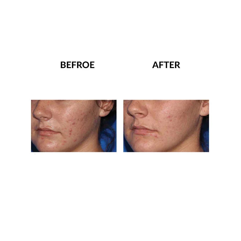 Mariposa Aesthetics & Laser Center Micropen PRP Skin Therapy Rejuvenation