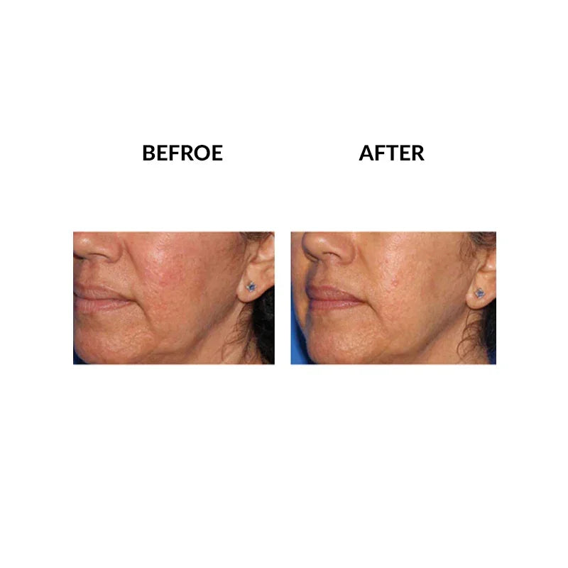 Mariposa Aesthetics & Laser Center Micropen PRP Skin Therapy Rejuvenation