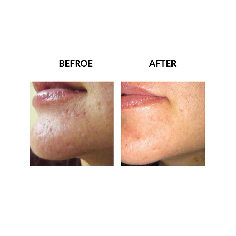 Mariposa Aesthetics & Laser Center Micropen PRP Skin Therapy Rejuvenation
