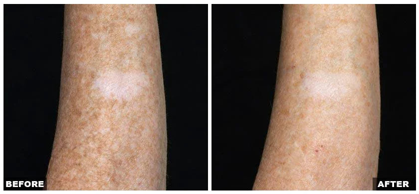 Mariposa Aesthetics & Laser Center Fraxel Laser Resurfacing Treatment