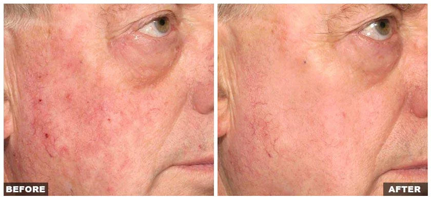 Mariposa Aesthetics & Laser Center Fraxel Laser Resurfacing Treatment