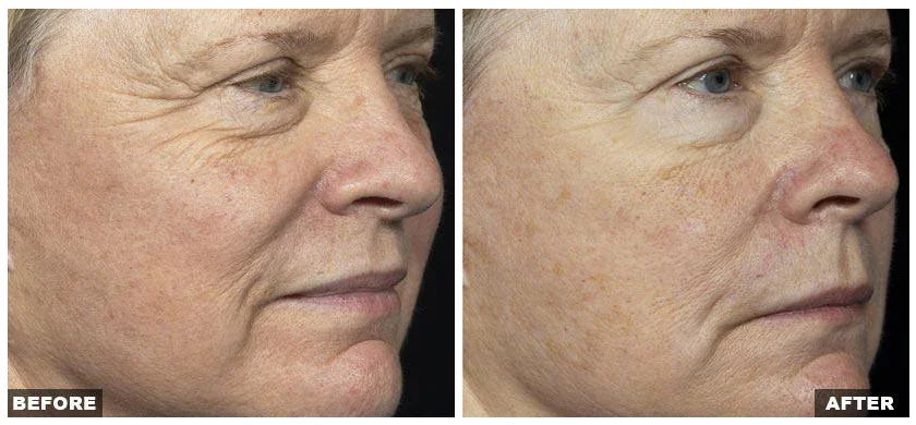 Mariposa Aesthetics & Laser Center Fraxel Laser Resurfacing Treatment