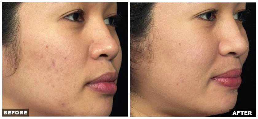Mariposa Aesthetics & Laser Center Fraxel Laser Resurfacing Treatment