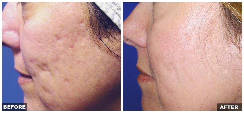 Mariposa Aesthetics & Laser Center Fraxel Laser Resurfacing Treatment