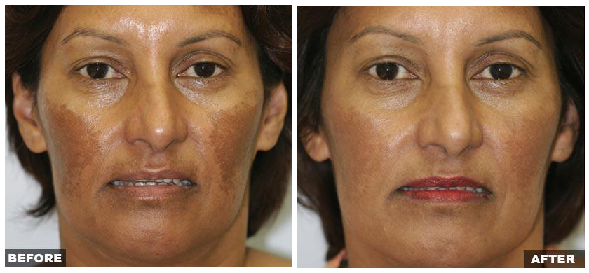 Mariposa Aesthetics & Laser Center Fraxel Laser Resurfacing Treatment