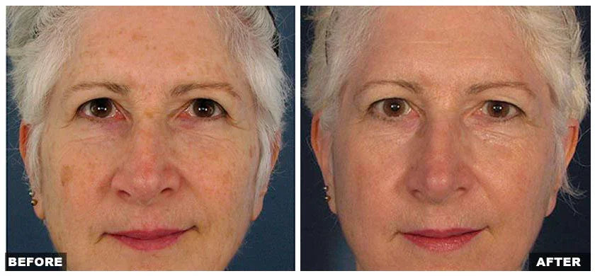 Mariposa Aesthetics & Laser Center Fraxel Laser Resurfacing Treatment
