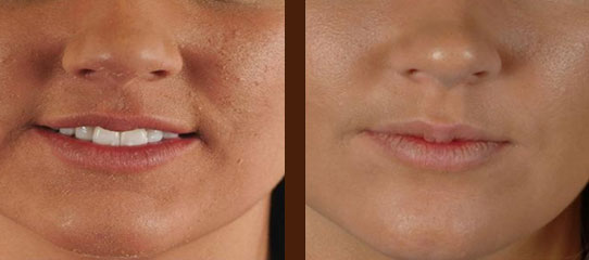 Mariposa Aesthetics & Laser Center Home Microdermabrasion Device