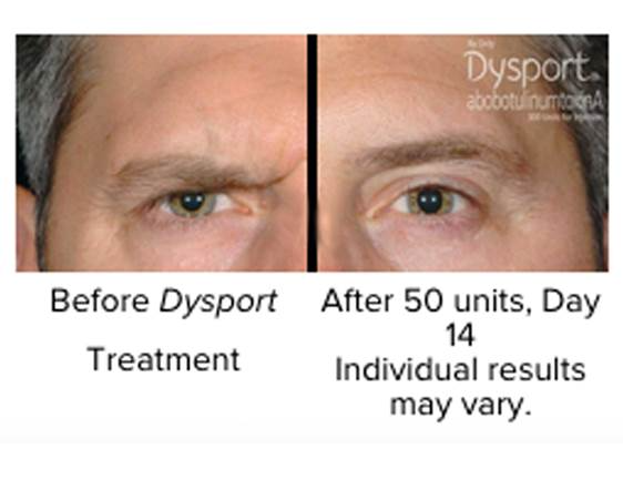 Mariposa Aesthetics & Laser Center Dysport Wrinkle Relaxer