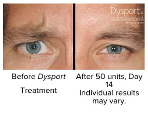 Mariposa Aesthetics & Laser Center Dysport Wrinkle Relaxer