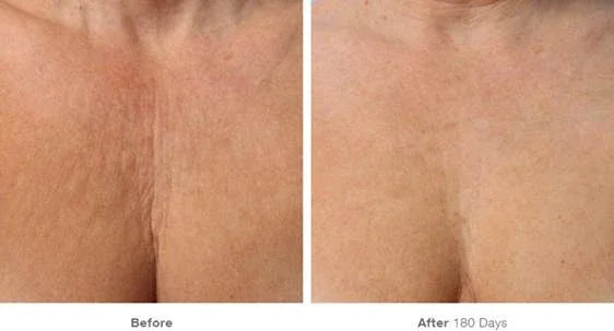 Mariposa Aesthetics & Laser Center Ultherapy® FACE Skin Tightening for Firm Skin