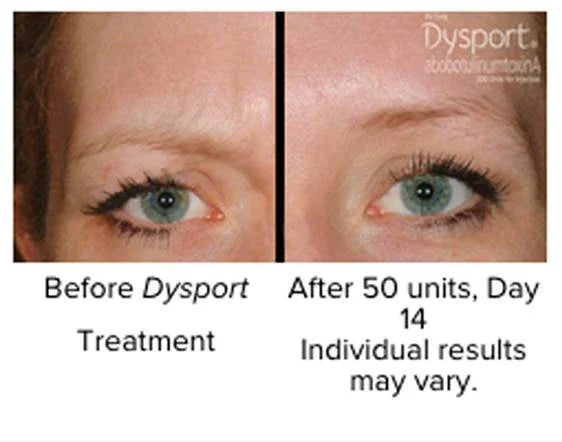 Mariposa Aesthetics & Laser Center Dysport Wrinkle Relaxer