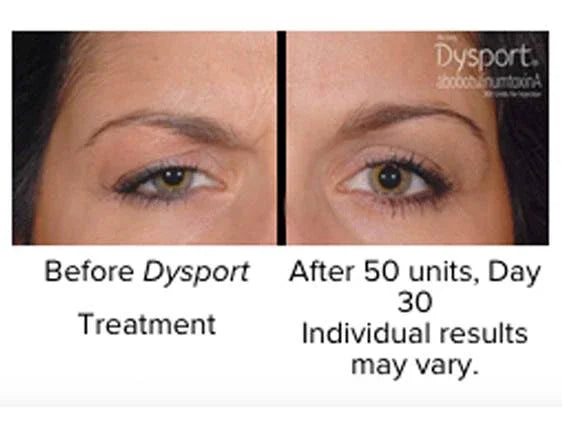 Mariposa Aesthetics & Laser Center Dysport Wrinkle Relaxer