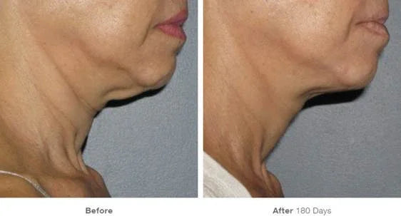 Mariposa Aesthetics & Laser Center Ultherapy® FACE Skin Tightening for Firm Skin
