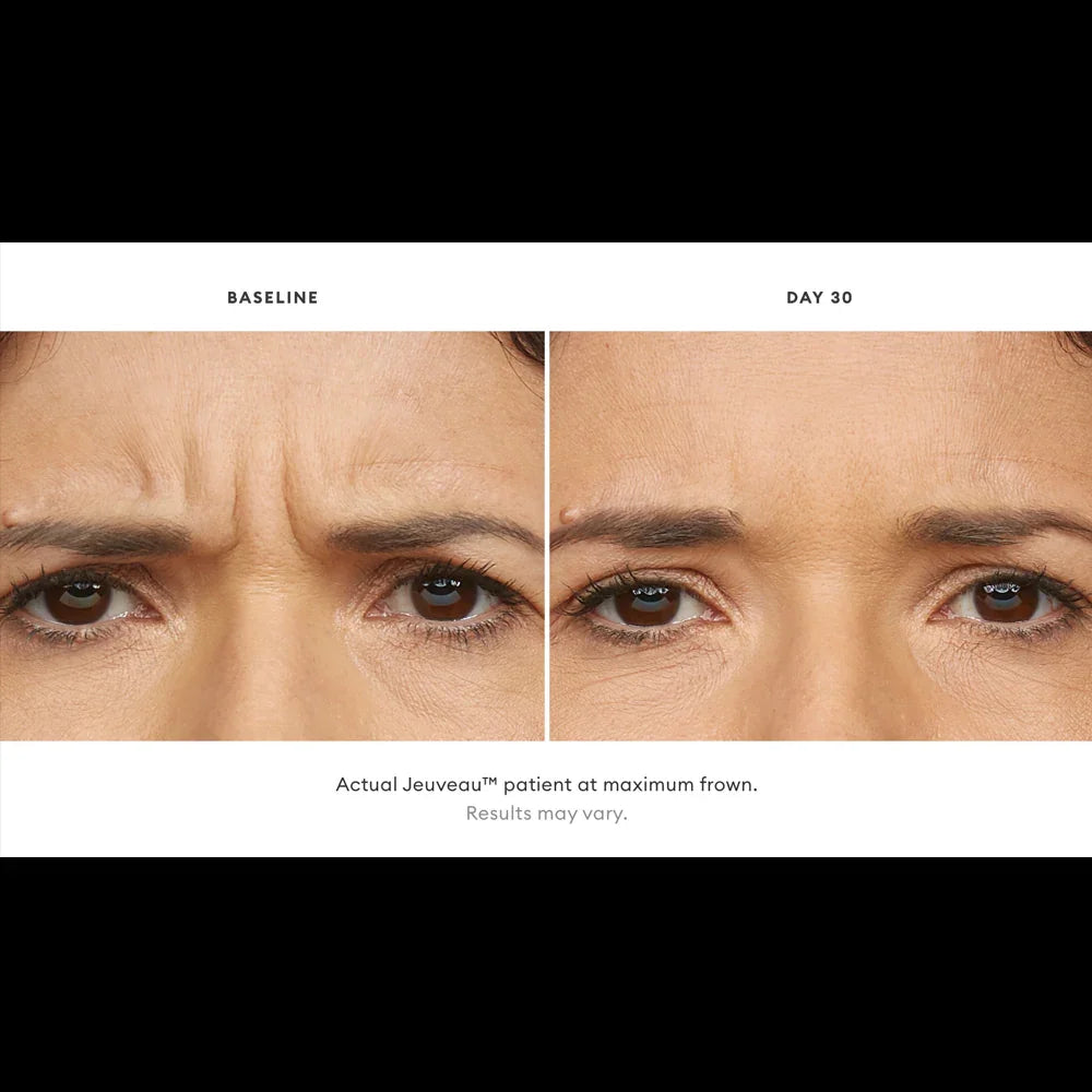 Mariposa Aesthetics & Laser Center Jeuveau Wrinkle Relaxer Neurotoxin