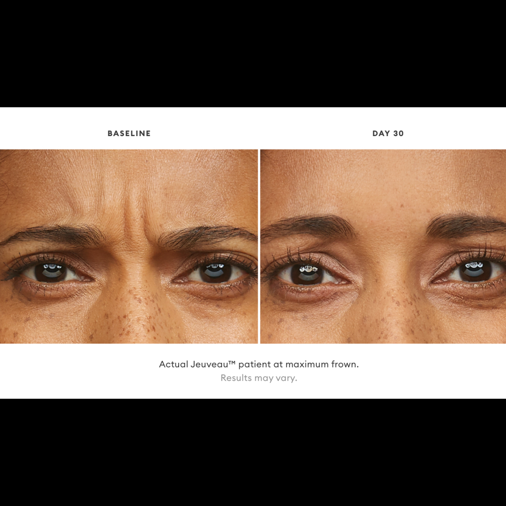 Mariposa Aesthetics & Laser Center Jeuveau Wrinkle Relaxer Neurotoxin