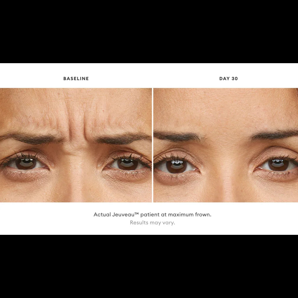 Mariposa Aesthetics & Laser Center Jeuveau Wrinkle Relaxer Neurotoxin