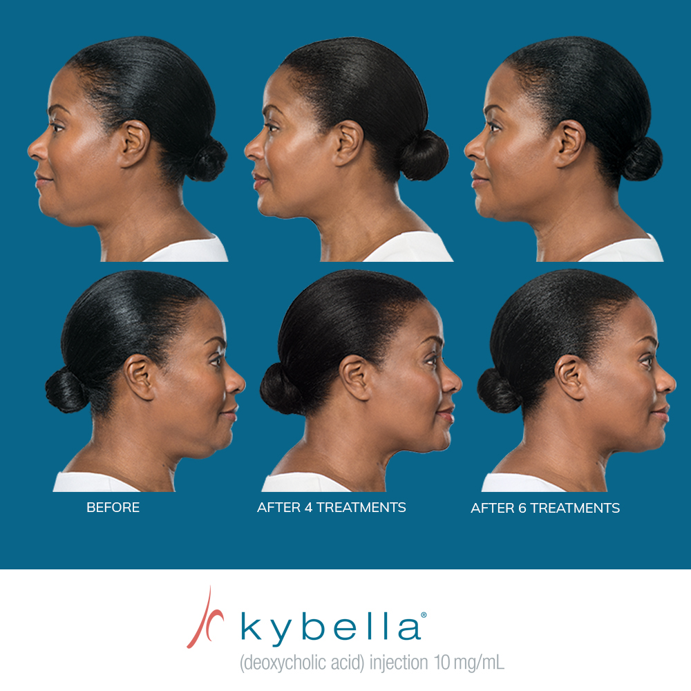Mariposa Aesthetics & Laser Center Kybella Chin Treatment for Double Chin Reduction