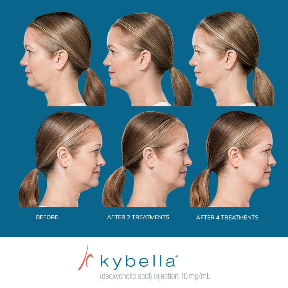 Mariposa Aesthetics & Laser Center Kybella Chin Treatment for Double Chin Reduction
