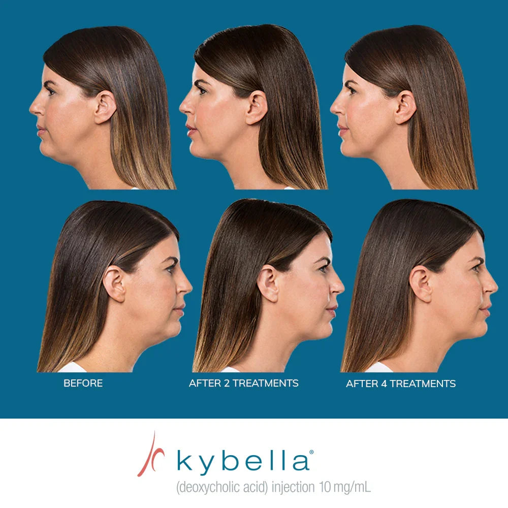 Mariposa Aesthetics & Laser Center Kybella Chin Treatment for Double Chin Reduction