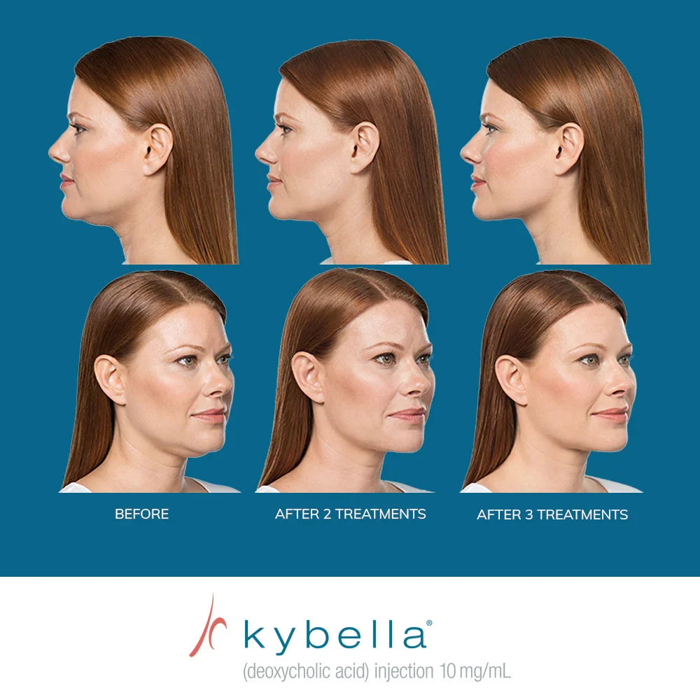 Mariposa Aesthetics & Laser Center Kybella Chin Treatment for Double Chin Reduction