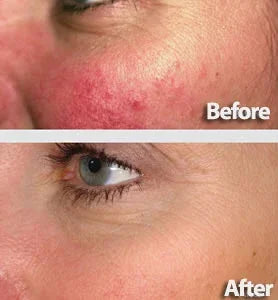 Mariposa Aesthetics & Laser Center Laser Genesis Treatment for Flawless Skin
