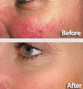 Mariposa Aesthetics & Laser Center Laser Genesis Treatment for Flawless Skin