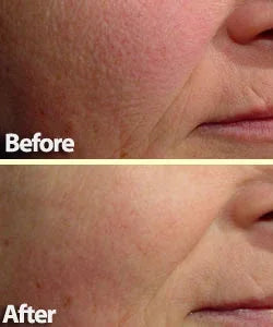 Mariposa Aesthetics & Laser Center Laser Genesis Treatment for Flawless Skin