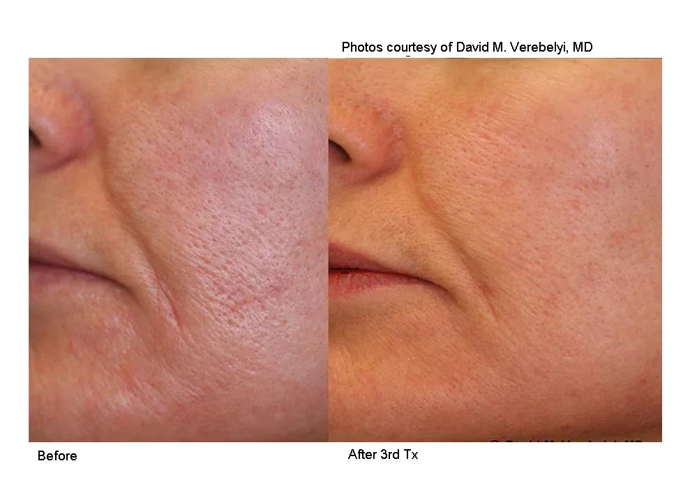 Mariposa Aesthetics & Laser Center Laser Genesis Treatment for Flawless Skin