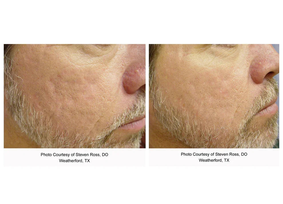 Mariposa Aesthetics & Laser Center Laser Genesis Treatment for Flawless Skin