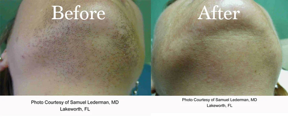 Mariposa Aesthetics & Laser Center Face & Neck Laser Hair Removal Solutions