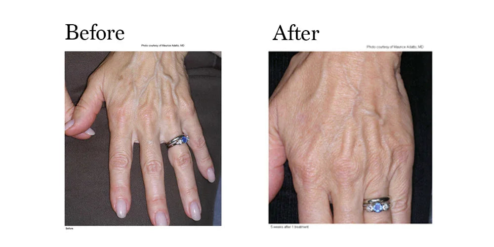 Mariposa Aesthetics & Laser Center LimeLight IPL Photofacial by Cutera®