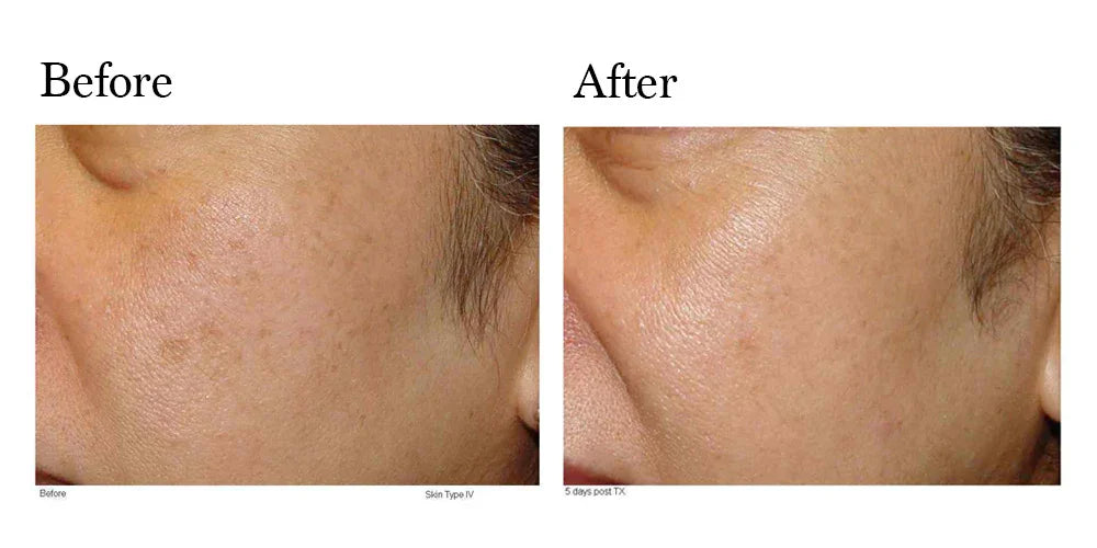 Mariposa Aesthetics & Laser Center LimeLight IPL Photofacial by Cutera®